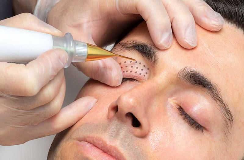 Vous voulez rajeunir votre apparence sans recourir à la chirurgie ? Venez découvrir le Plasma Lift en promotion dans votre institut R’Pur Prado Marseille 13008