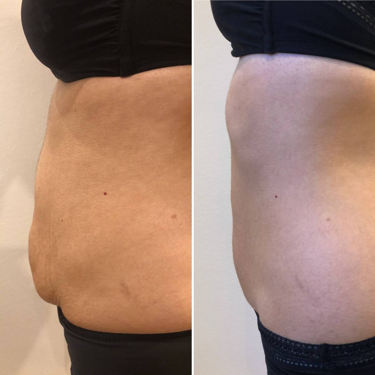 Retendre la peau de son ventre naturellement et sans intervention chirurgicale à Marseille prado 13008