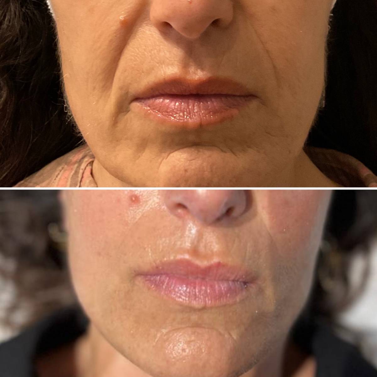 RADIOFREQUENCE : Raffermissez et liftez naturellement la peau relâchée de votre visage ou corps dans votre institut R’Pur Prado Marseille 13008