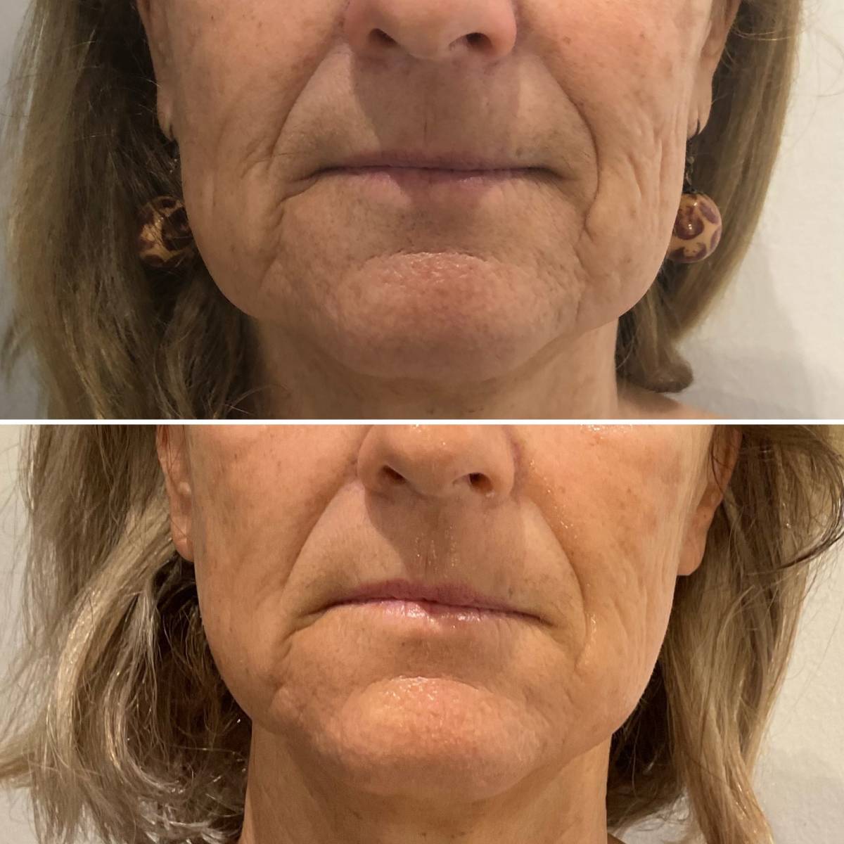 RADIOFREQUENCE : Raffermissez et liftez naturellement la peau relâchée de votre visage ou corps dans votre institut R’Pur Prado Marseille 13008