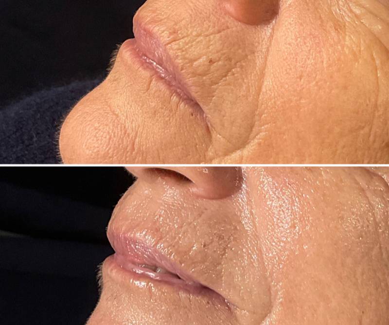 Résultat avant après jet Peel led et radiofréquence Marseille 13008