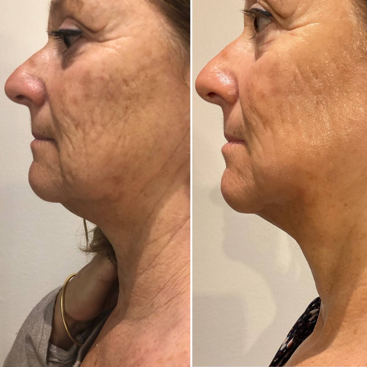 RADIOFREQUENCE : Raffermissez et liftez naturellement la peau relâchée de votre visage ou corps dans votre institut R’Pur Prado Marseille 13008